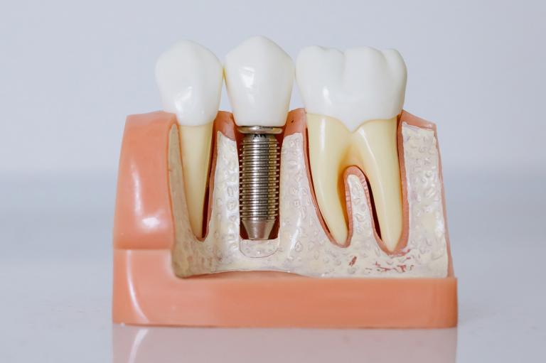 Implantes Dentales